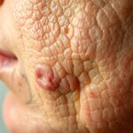Zmiany skórne w chorobach reumatycznych: objawy i diagnostyka